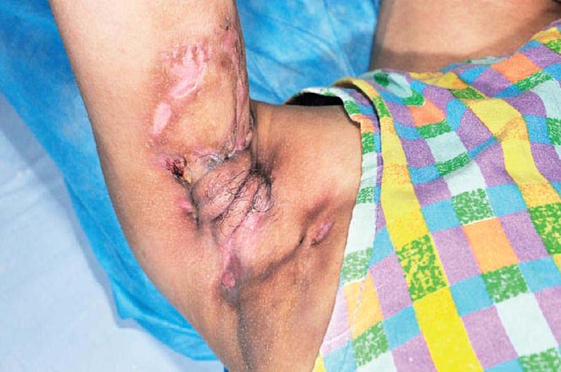 化膿性汗腺炎